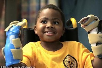 First child double hand transplant launched  in America 