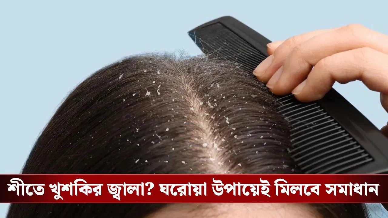শীতে খুশকির সমস্যা? জেনে নিন ঘরোয়া উপায়ে দ্রুত দূর করার সহজ কৌশল