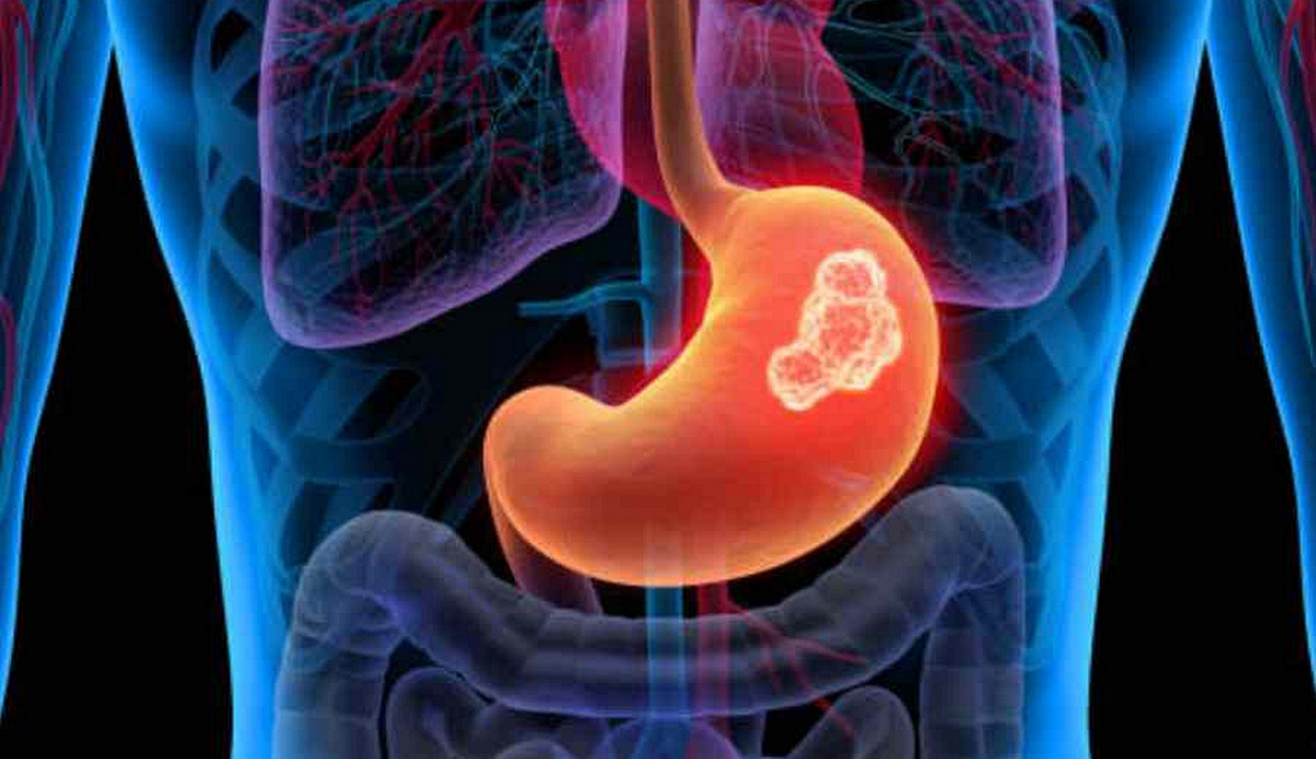 বদহজম ভেবে ভুল নয়! পেটের ক্যানসার ঝুঁকি কমাবে যে ৫ খাবার