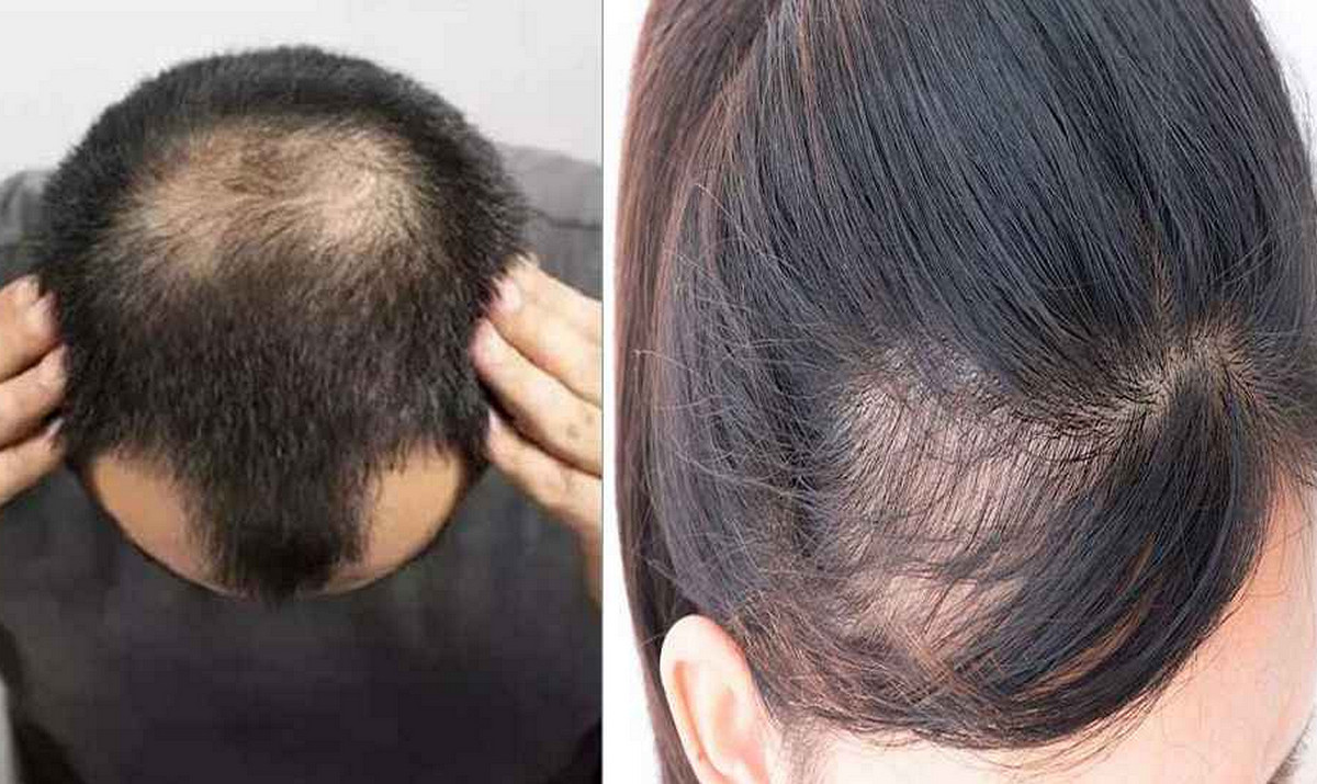 সাবধান! আপনার এই ৮টি ভুলেই কি দ্রুত টাক পড়ে যাচ্ছে? আজই জানুন