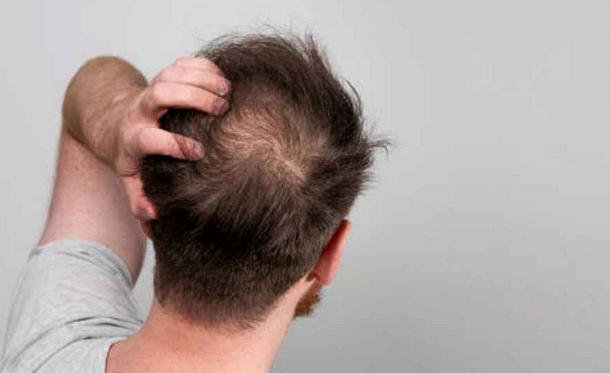 কেন অকালে চুল হারাচ্ছেন পুরুষরা? আজই বদলে ফেলুন এই ৫ অভ্যাস