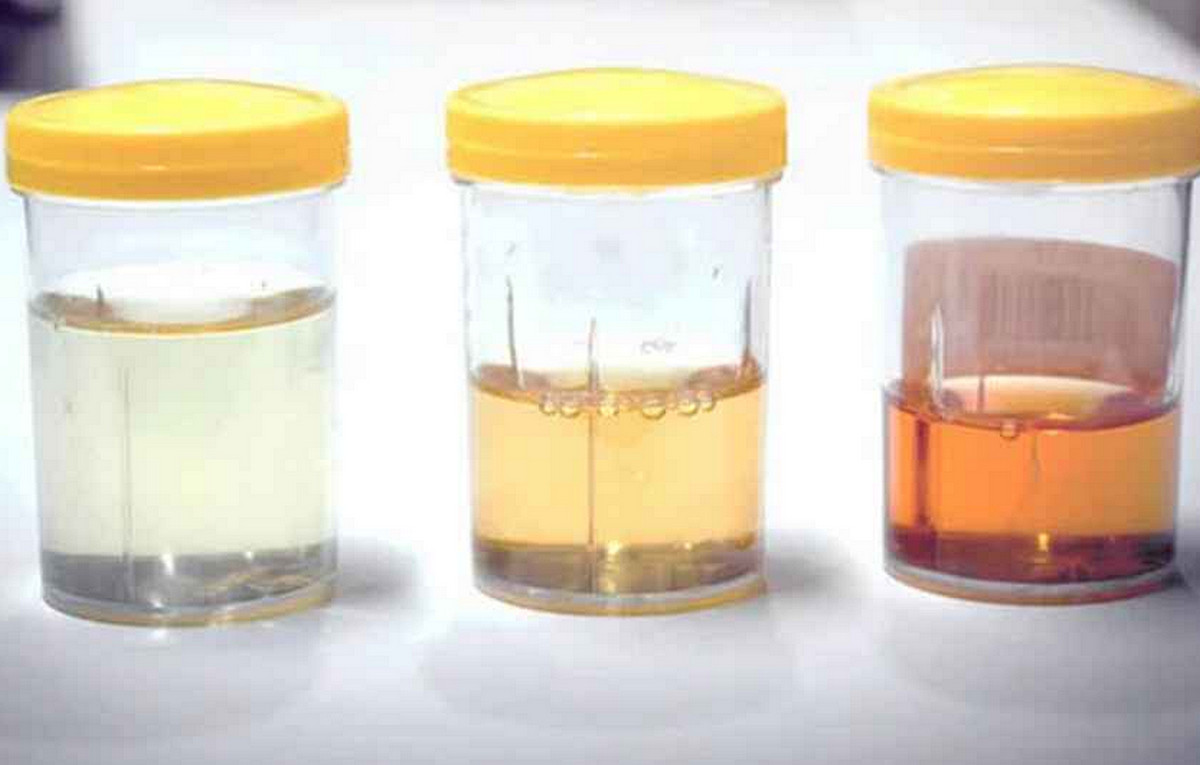 প্রস্রাবের রঙই বলবে শরীরে কোন রোগ বাসা বেঁধেছে