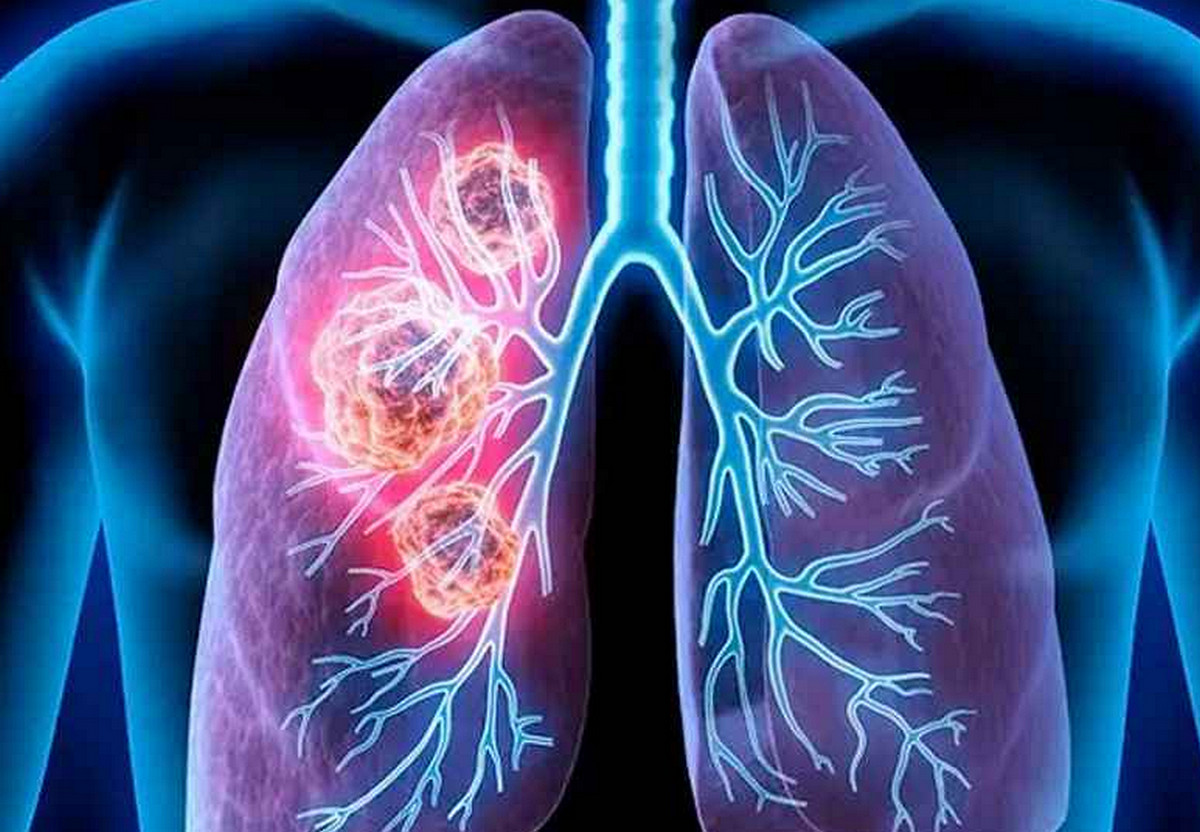 ত্বকের ৫ পরিবর্তনেই লুকিয়ে ফুসফুস ক্যানসারের ইঙ্গিত!