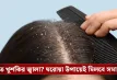 শীতে খুশকির সমস্যা? জেনে নিন ঘরোয়া উপায়ে দ্রুত দূর করার সহজ কৌশল