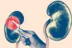 কিডনি কেন অকেজো হয়? আসল কারণ খুঁজে পেলেন গবেষকরা