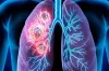 ত্বকের ৫ পরিবর্তনেই লুকিয়ে ফুসফুস ক্যানসারের ইঙ্গিত!